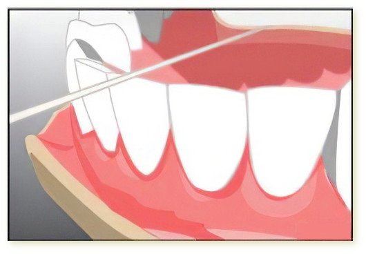 conseils patients dentaires Crolles fil dentaire