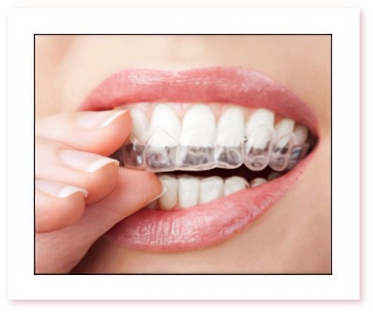 Conseils patients dentaires Crolles grincement des dents