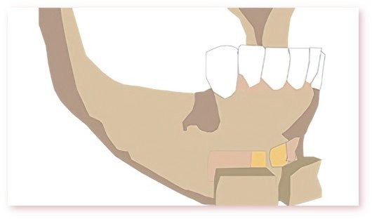 Greffes osseuses dentaires Crolles