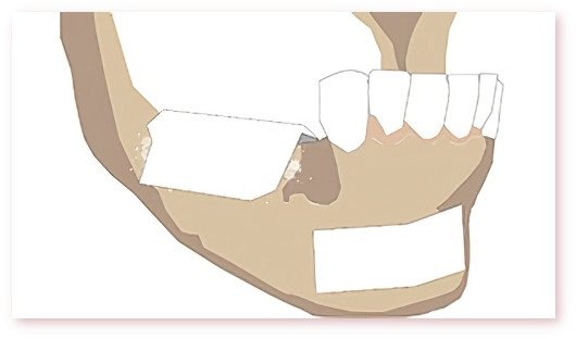 Greffes osseuses dentaires Crolles
