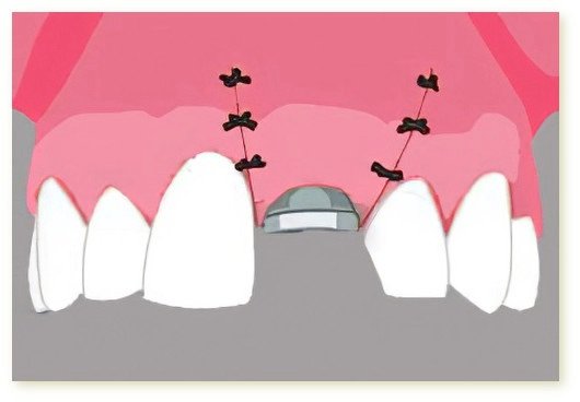 Implants dentaires Crolles