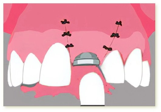 Implants dentaires Crolles