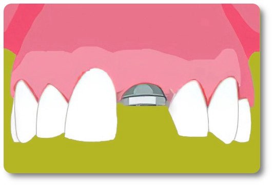 Implants dentaires Crolles