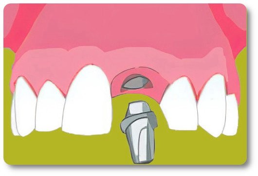 Implants dentaires Crolles