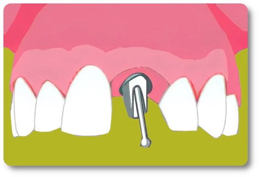 Implants dentaires Crolles