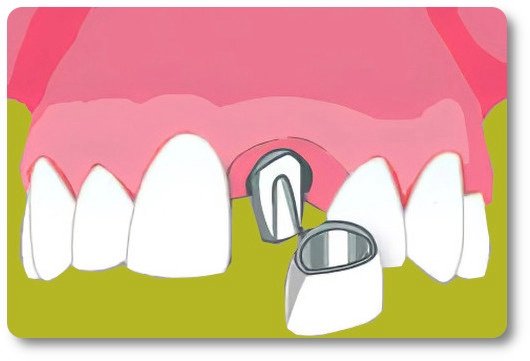 Implants dentaires Crolles