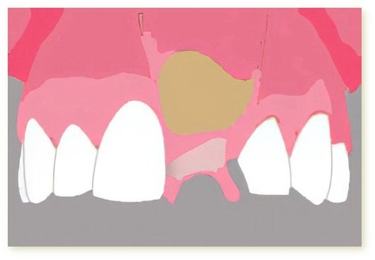 Implants dentaires Crolles