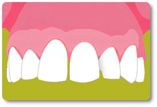 Implants dentaires Crolles