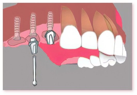 Implants dentaires Crolles