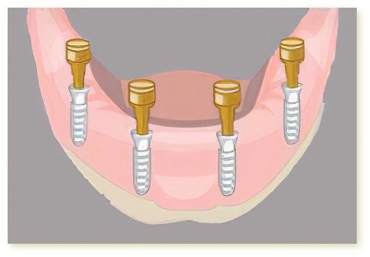 Implants dentaires Crolles