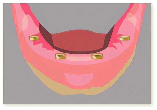 Implants dentaires Crolles
