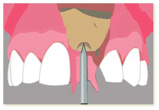Implants dentaires Crolles