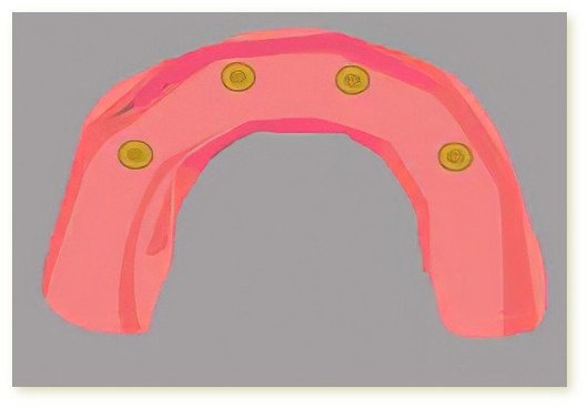 Implants dentaires Crolles