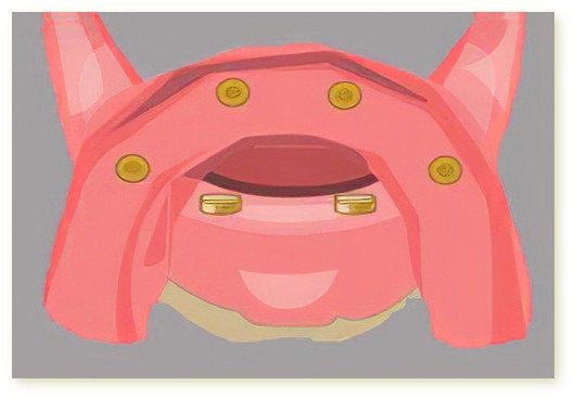 Implants dentaires Crolles