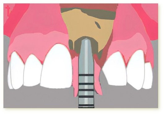 Implants dentaires Crolles