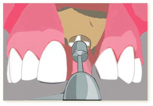 Implants dentaires Crolles