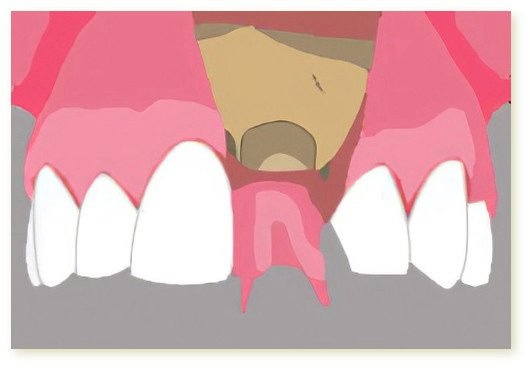 Implants dentaires Crolles